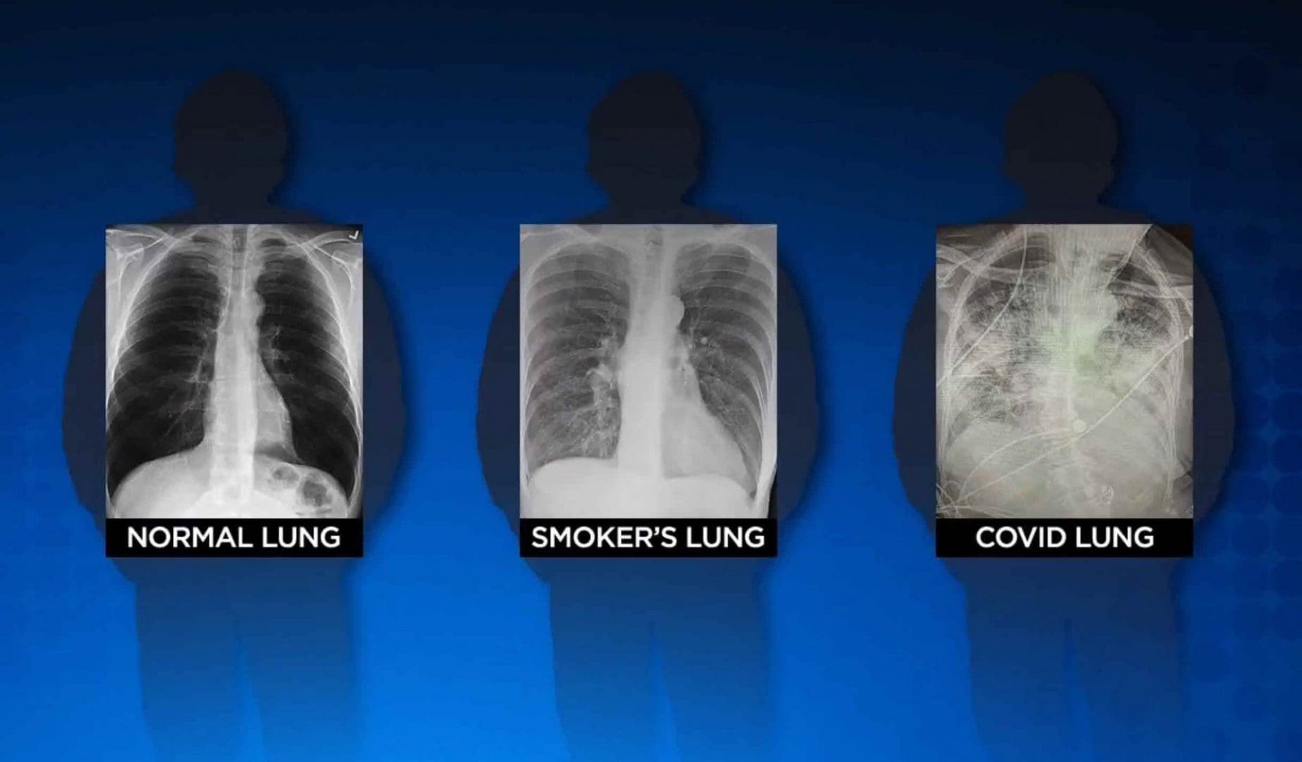 Texas trauma surgeon says "post-COVID lungs look worse than any type of terrible smokers lung we've ever seen"